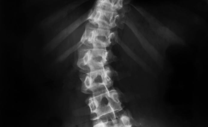 Physiotherapy for Scoliosis